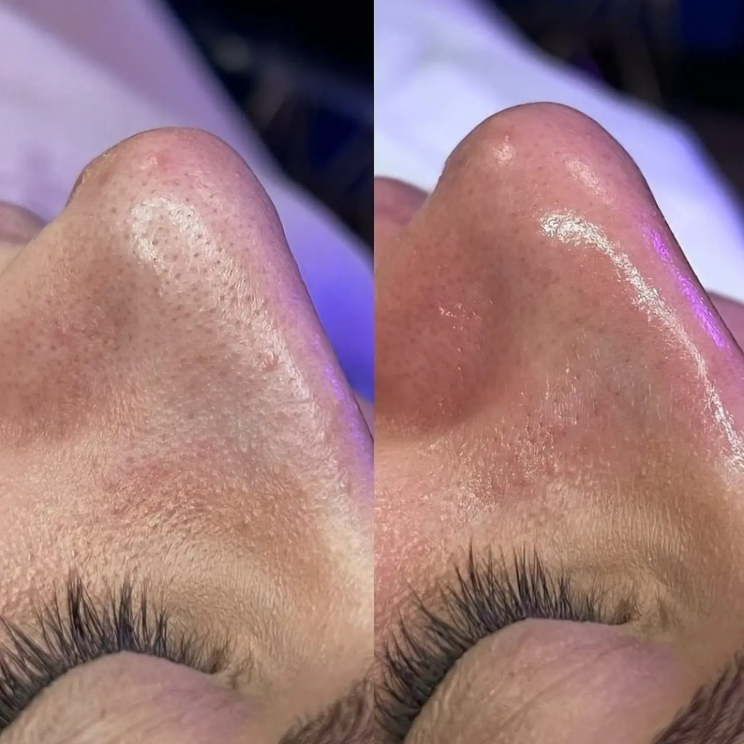 Hydrafacial™ von NOYA Aesthetics