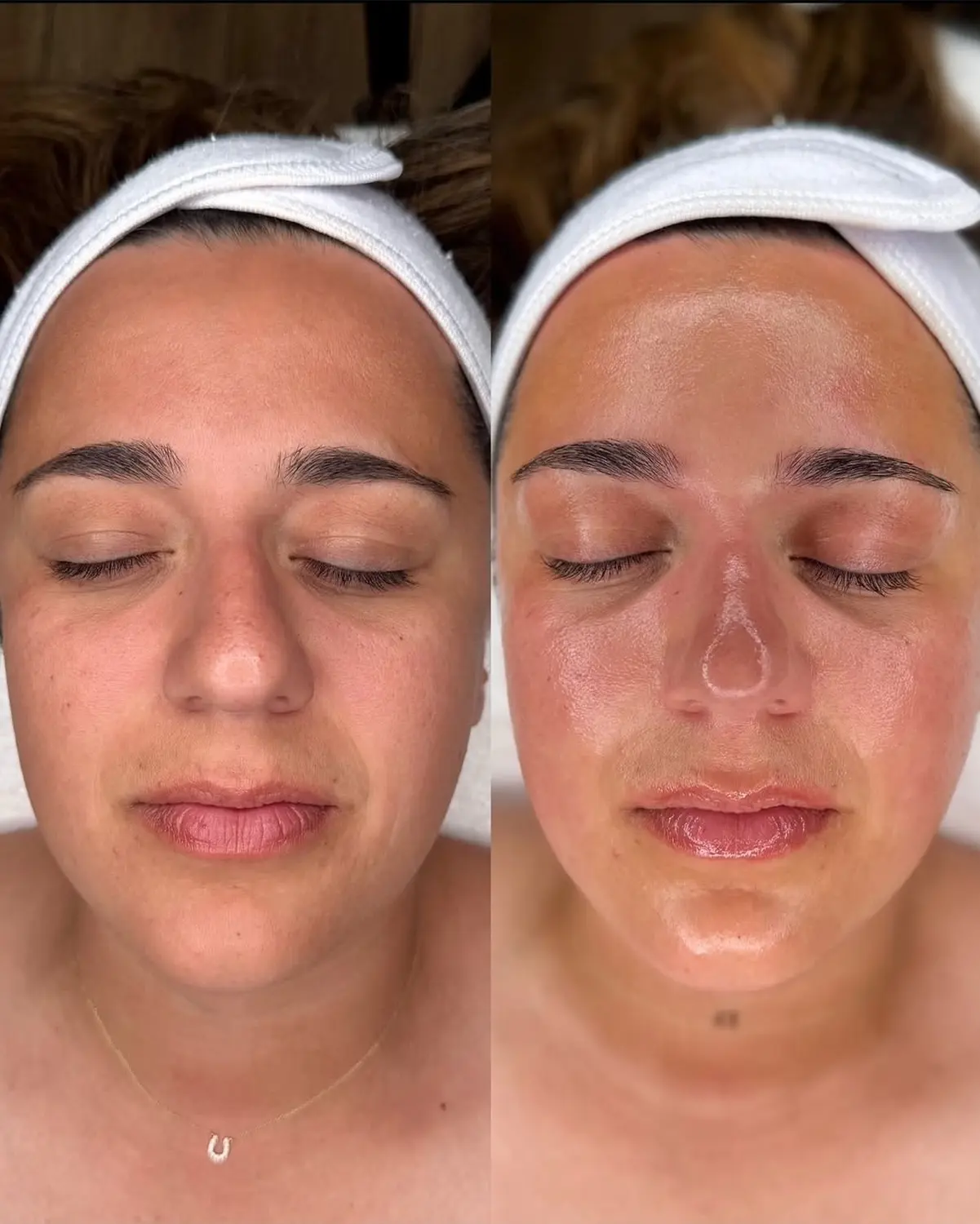 Microneedling von NOYA Aesthetics