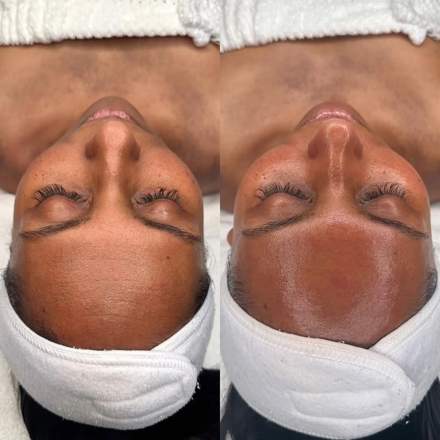 Microneedling von NOYA Aesthetics