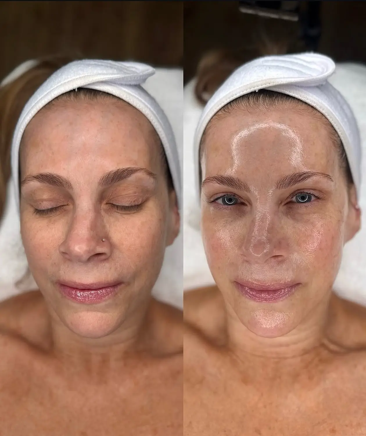 Microneedling von NOYA Aesthetics