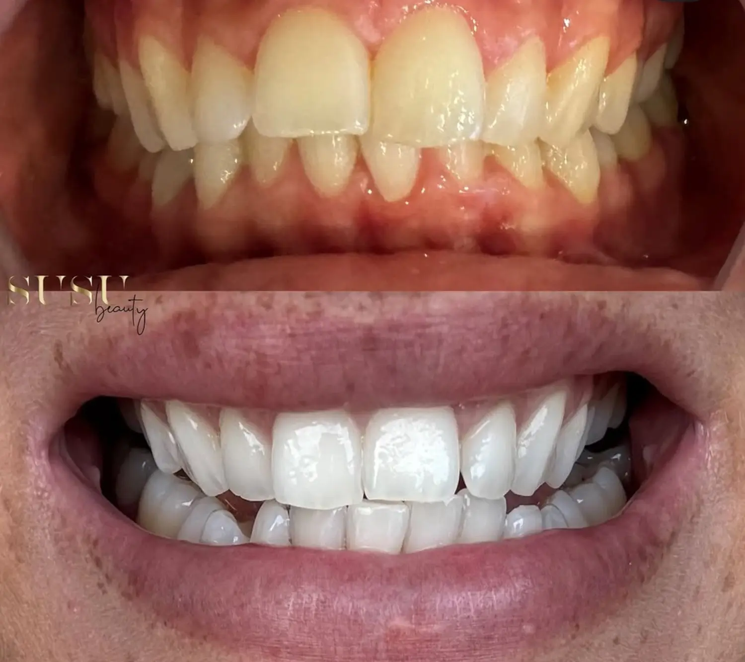 NOYA Glow Zahnbleaching