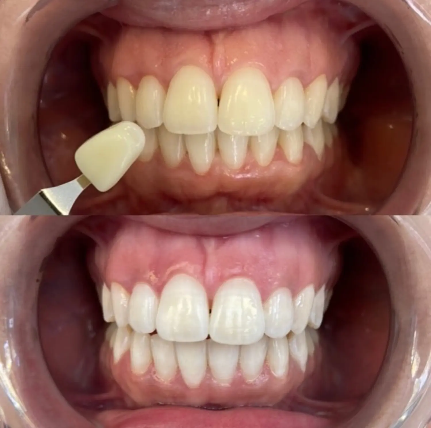 NOYA Glow Zahnbleaching