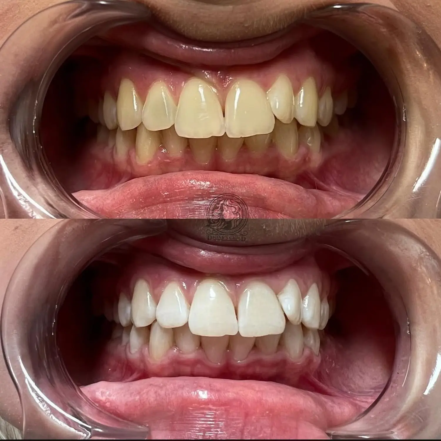 NOYA Glow Zahnbleaching